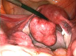 image fibroid