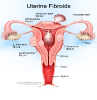 fibroid 2